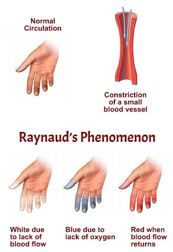 Raynaud syndrome, Raynaud's Phenomenon, disease, gangrene and skin sores, manoeuvres